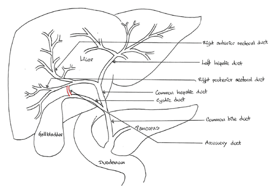 FULL TEXT Management of an injured accessory hepatic duct during